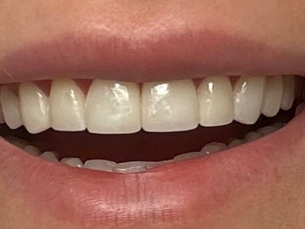 After crowns treatment