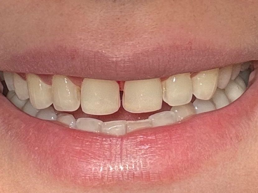 Before crowns treatment