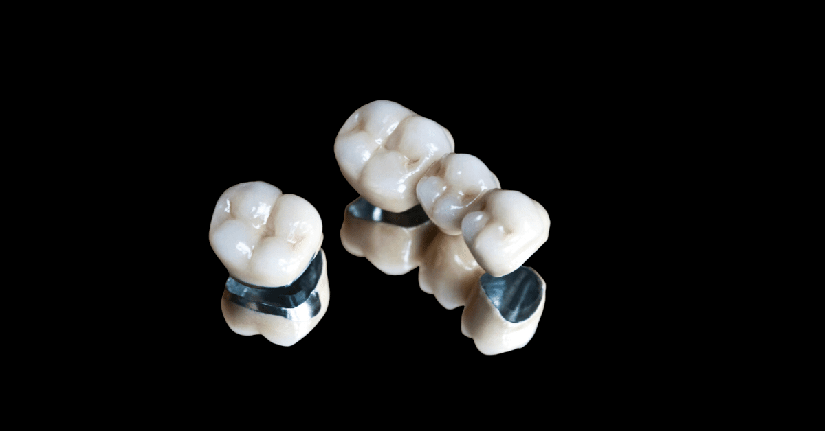 Dental crowns and bridges