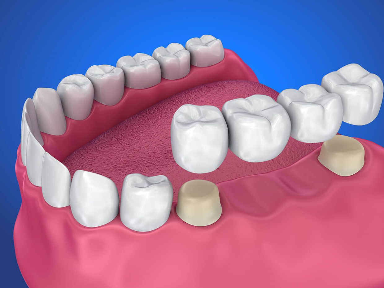 Dental crowns restoration