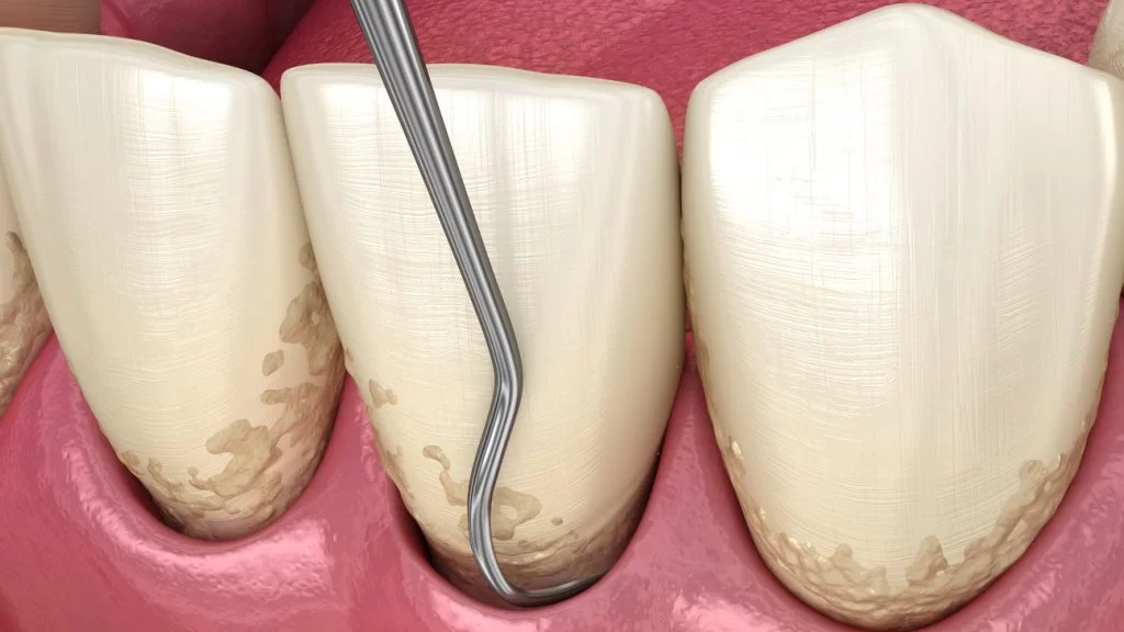 Dental scaling