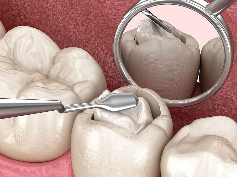 Filling material options