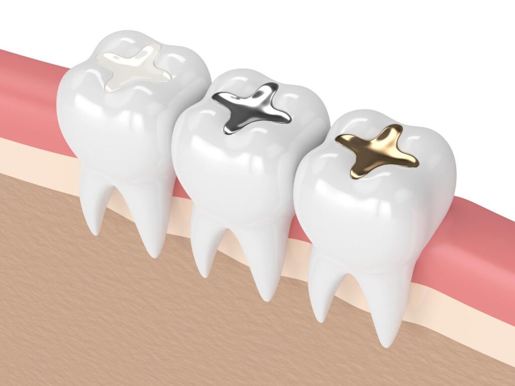 Dental filling restoration