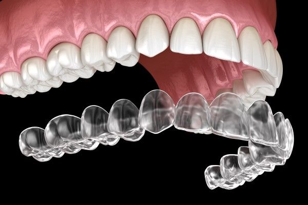 Clear aligner treatment