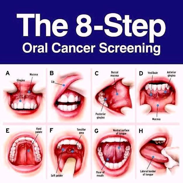 Oral cancer screening