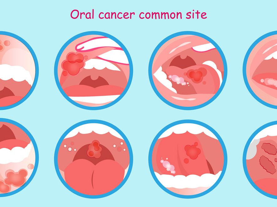 Oral cancer screening procedure