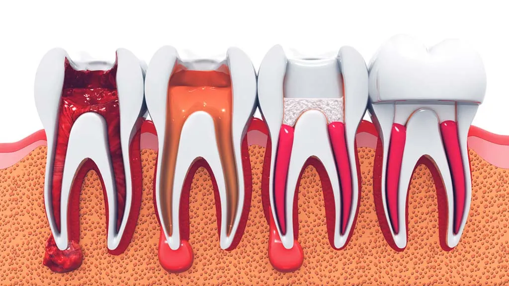Root canal treatment
