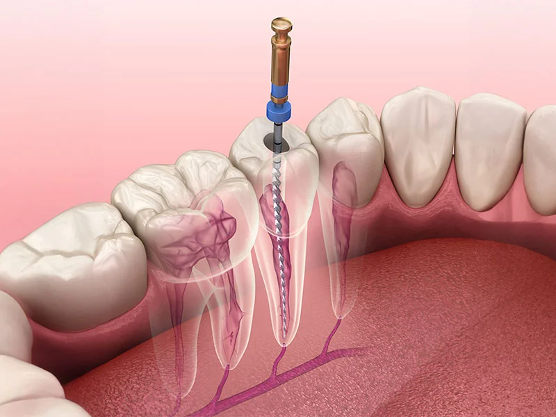 Root canal procedure