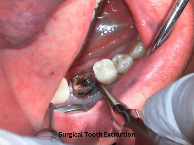 Dental extraction