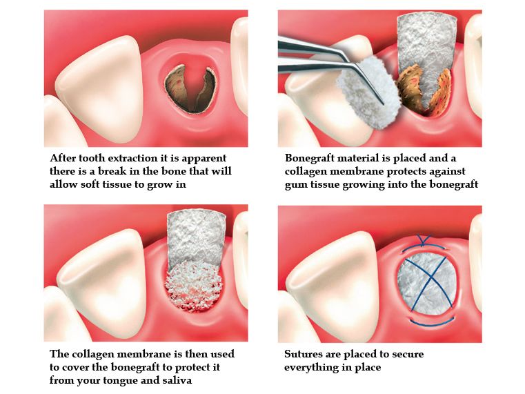 Post-extraction care
