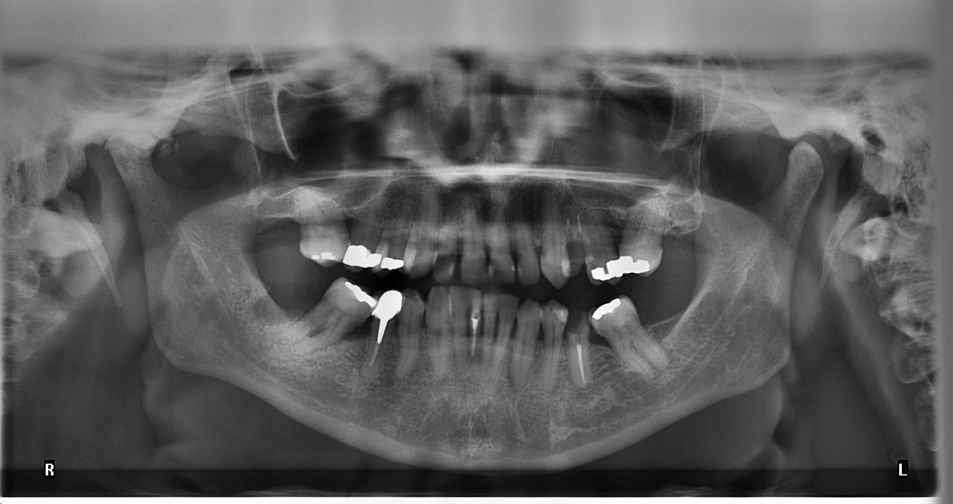 Digital dental X-rays