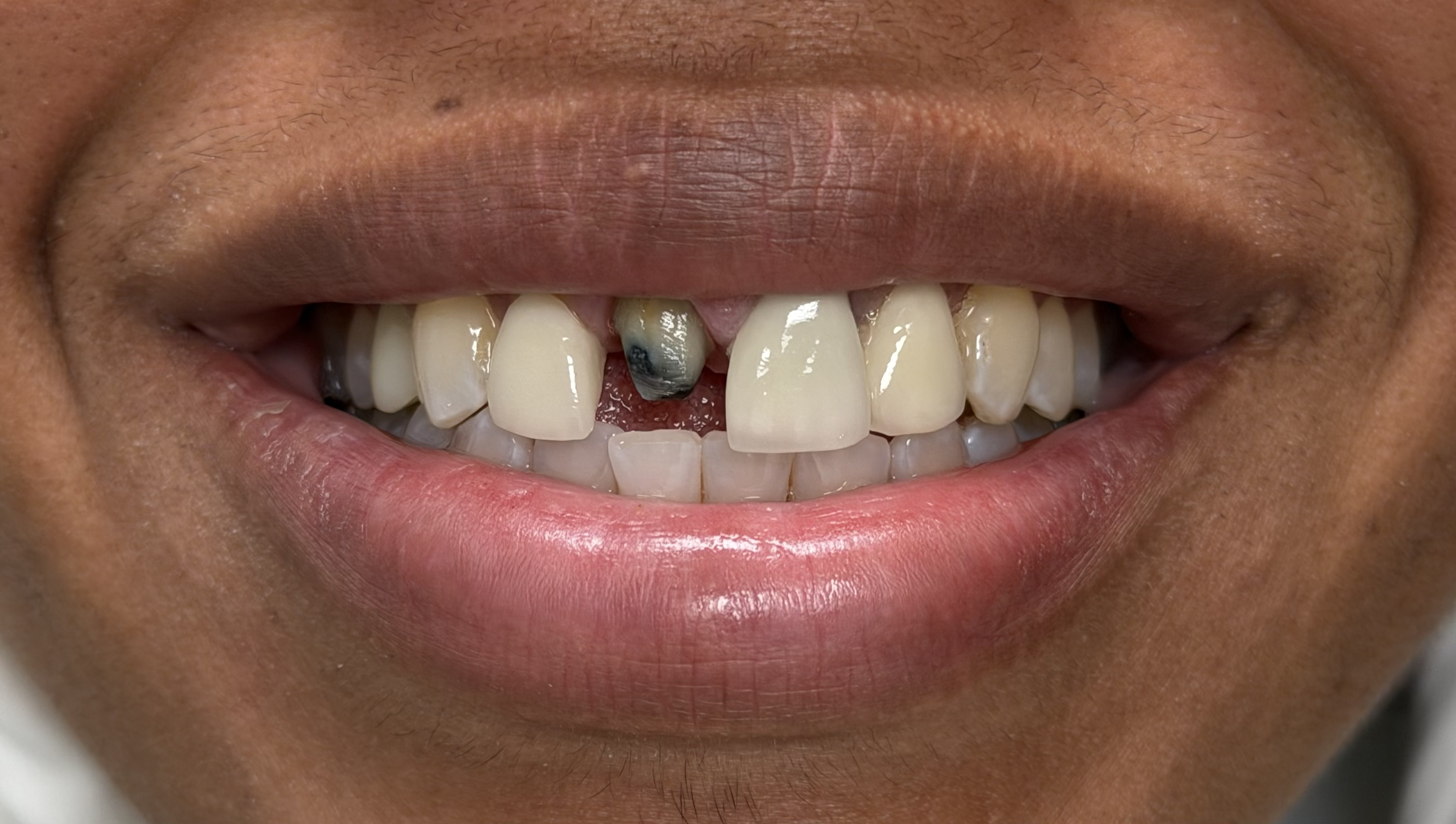 Before veneers treatment