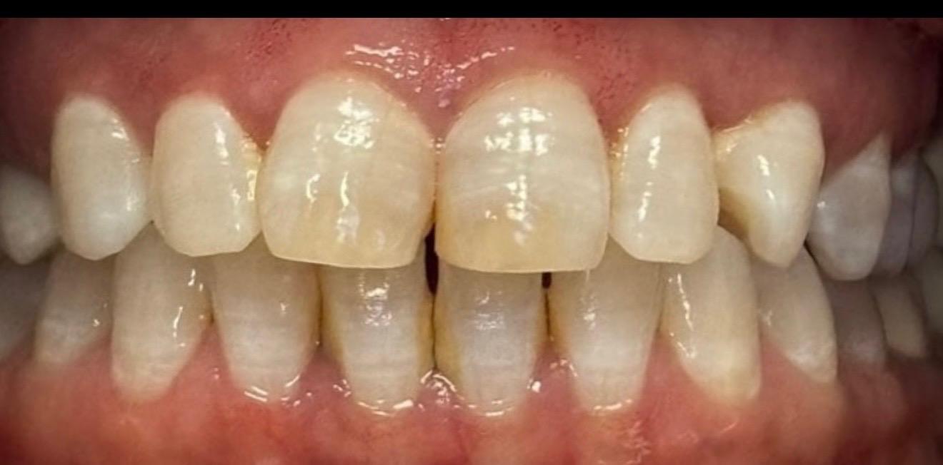 Before smile transformation