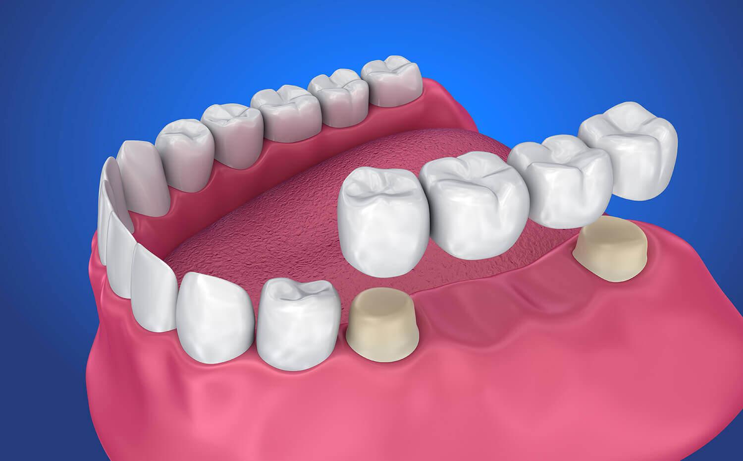 Dental crowns and bridges restoration