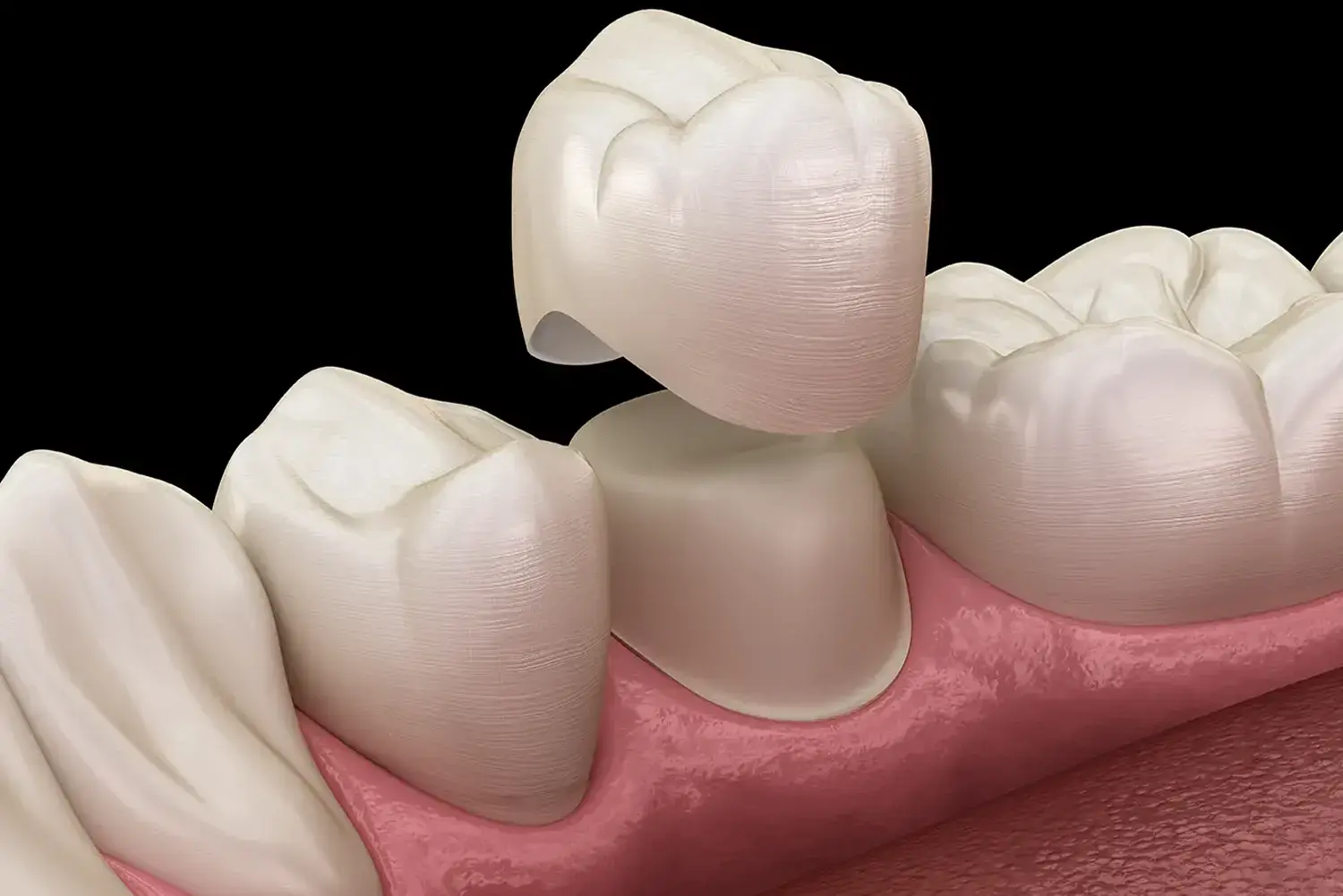 Temporary crown and bridge restoration