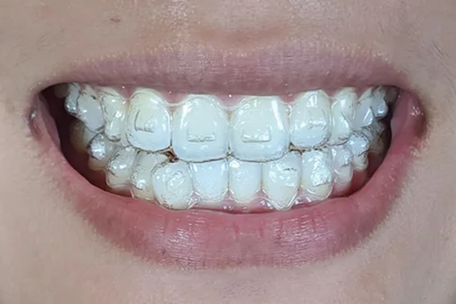 After Invisalign